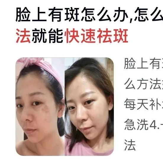 祛斑美白护肤品信息流广告投放的流程