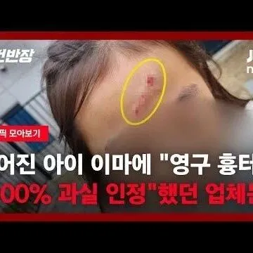찢어진 아이 이마 영구 흉<em>터</em> 남는다는데100 과실 <em>인</em>정했던 ..