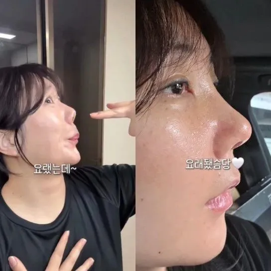 허안나, <em>코</em> <em>재</em>수술 결과 공개…달라진 콧대 <em>인</em>증