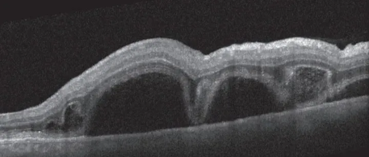 Vogt-小柳-<em>原田</em>综合征（Vogt-Koyanagi-Harada，VKH）