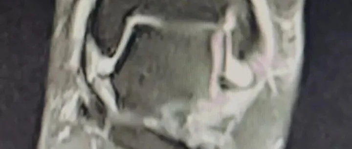 Ankle sprains and <em>instability</em>