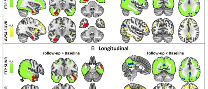 <em>Ann</em> Neurol: 阿尔茨海默病中海马体网络连接的纵向变化
