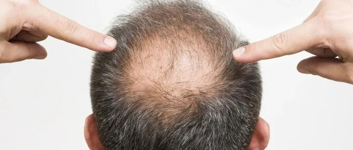 未脫單先掉<em>髮</em>？真人實驗證明：外泌體治療僅6週頭<em>髮</em>密度+69%、掉<em>髮</em>量↓60%！