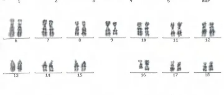 <em>AML</em>伴CBFB::MYH11融合（WHO2024）