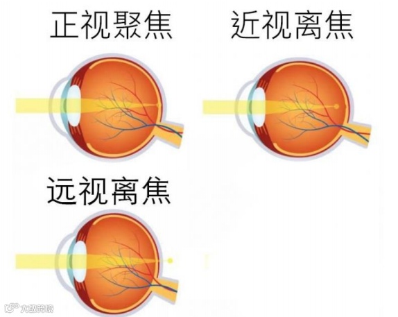 什么是对比敏感度多点离焦概念大扫盲_https://www.jmylbn.com_新闻资讯_第1张