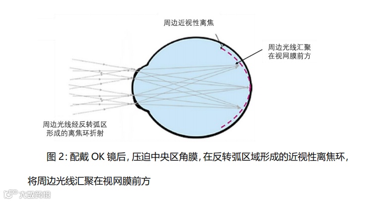 什么是对比敏感度多点离焦概念大扫盲_https://www.jmylbn.com_新闻资讯_第3张