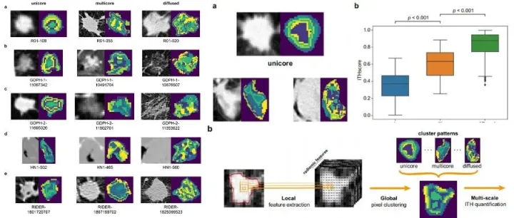 SCI文献讲解｜周日上午九点直播：基于多尺度放射学特征综合定量NSCLC的肿瘤内异质性