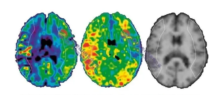 第二十二届磁共振ASL（动脉自旋标记）数据处理班（北京，12.4-7）