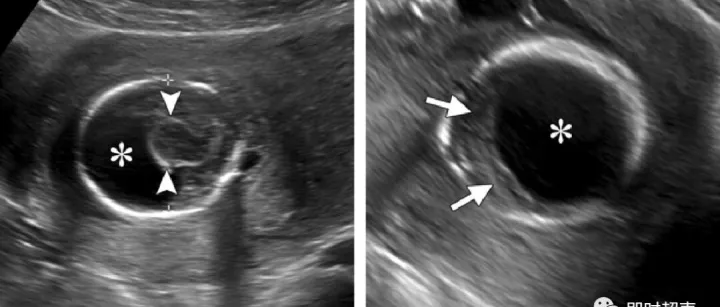 前脑无<em>裂</em>畸形