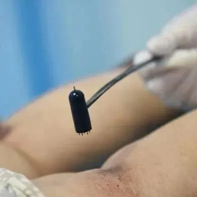 委中<em>穴</em>—— 放血可治恶疮、顽癣！非常厉害！