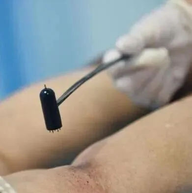 委中<em>穴</em>放血可治恶疮,顽癣.非常厉害！