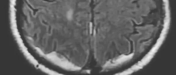 弥漫性轴索损伤（diffuse axonal injury，<em>DAI</em>）