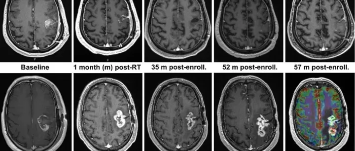放疗+纳武利尤单抗+<em>IDO</em>1抑制剂治疗IDH野生型胶质母细胞瘤患者的I期试验结果- 协和神经肿瘤专栏