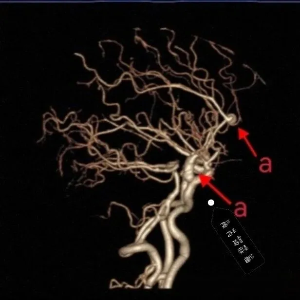 头颈部血管的"高清地图"—<em>CTA</em>检查