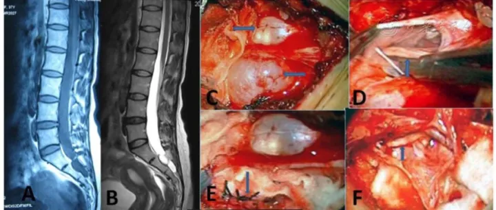 椎管囊肿：从成因到治疗<em>的</em><em>全面</em><em>解析</em>