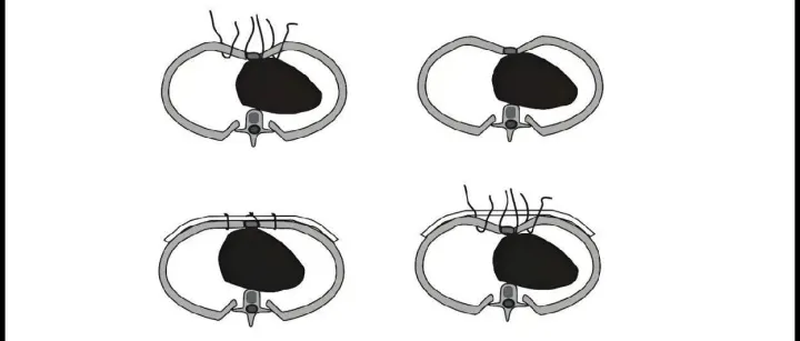 Wang手术被<em>Wikipedia</em>收录