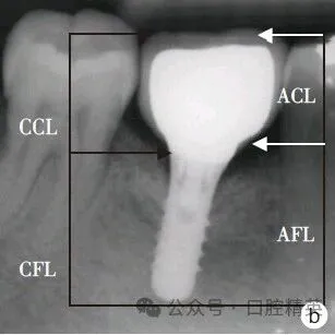 种植义齿冠根比与临床<em>并发</em>症