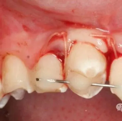 种植<em>牙</em>时代，我们为什么还要费心去救<em>牙</em>？