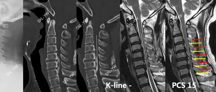 袁文：PCS评分在颈后路椎管扩大椎板成形术中神经功能恢复情况的预测价值