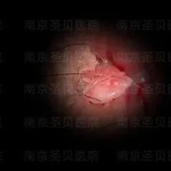 尖锐湿疣初期白色丘疹（内附图）