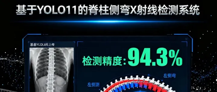 基于YOLO11的脊柱侧弯X射线检测系统（Python源码+数据集+Pyside6界面）