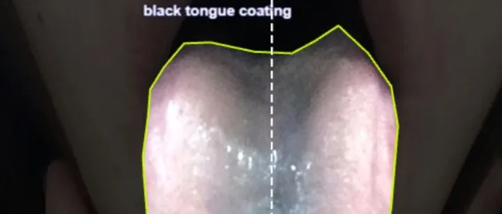 智慧医疗之舌象<em>分析</em> 舌苔分割<em>数据</em>集 舌诊目标<em>检测</em><em>数据</em>集 舌苔<em>分析</em><em>数据</em>集 舌象<em>分析</em>图像<em>数据</em>集