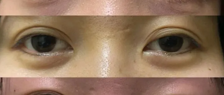 <em>贴了</em>双眼皮贴后别再“硬扯”了！这几招教你安全变美！