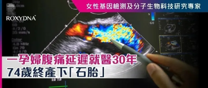 一孕婦腹痛<em>延</em><em>遲</em>就醫30年 74歲終產下「石胎」