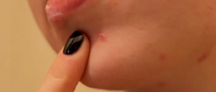 一颗痘竟让肺“千疮百孔”？真的别随便挤了，严重可危及生命！