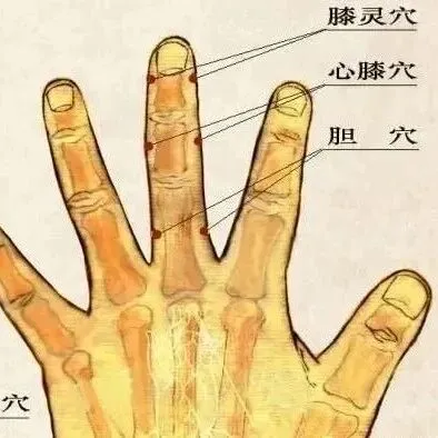 【针灸】治疗膝关节炎的三个奇穴