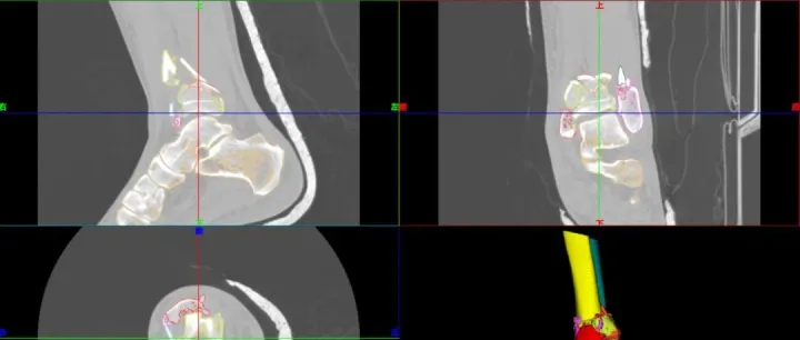 护仁仁软件：让Pilon骨折手术迈入“数智精准时代”
