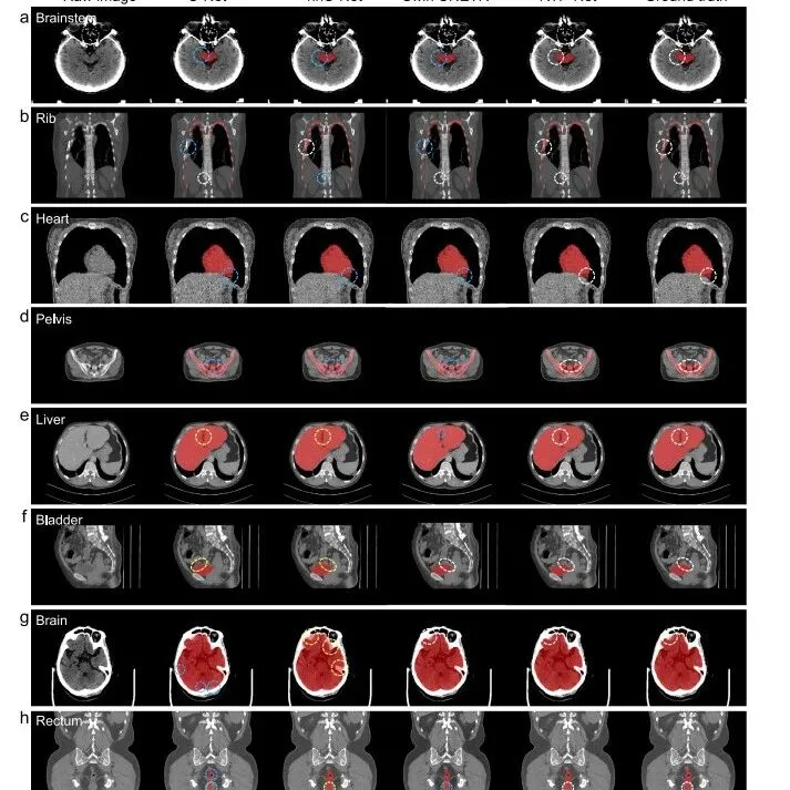 Nature | 医学影像分析中使用nnUNet不够有新意？来看看顶刊也在用的RTP-Net！