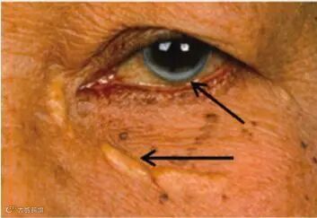 心内科医生 血脂高不高,看脸就知道,血脂升高时,脸上会有3症状