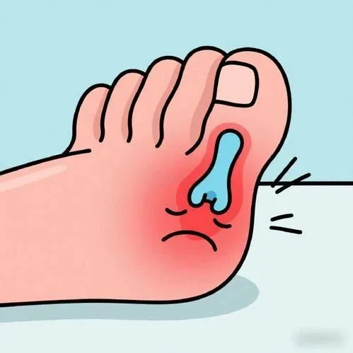 痛风发作时该怎么办？如何科学自救与管理？