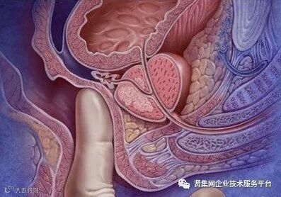 Enzalutamide提高转移性激素敏感型前列腺癌患者的生存率