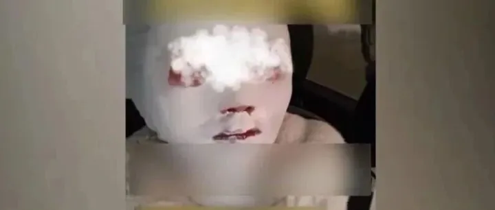 第一次用就炸了！女子面部、頸部被燙傷……