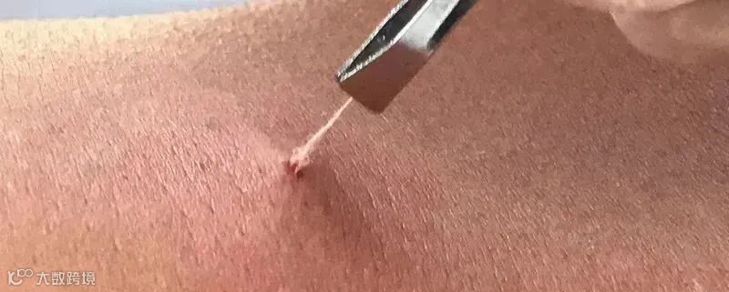 羊毛疔截根疗法培训