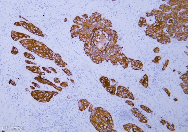 fe93bfc09da146b59c206a3dbaeb0763_V0280-esophageal-squamous-cell-carcinoma.jpg