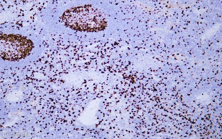 Ki-67 恶性黑色素瘤.jpg