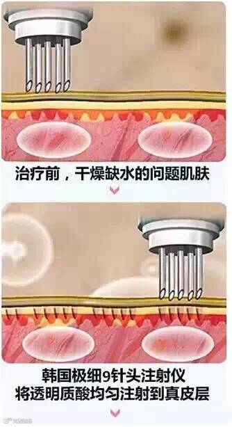 水光注射答疑大全【这些你知道了吗】