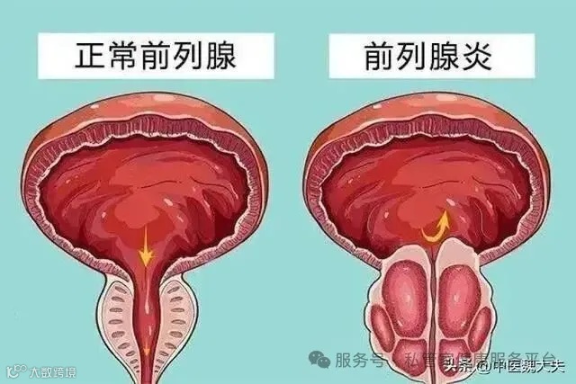 得了前列腺炎怎么办？难治疗吗？医生告诉你