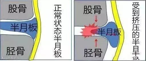 半月板损伤及注意事项 - 山西华晋骨科医院