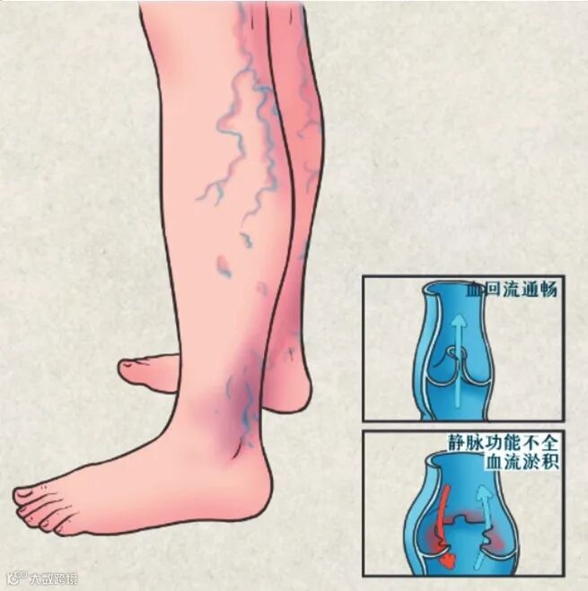 下肢静脉曲张示意图