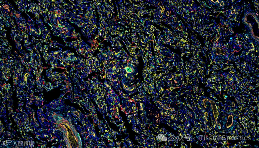 ROI 03 - (CD8 + CD68 163+) on (Overlay + 加粗).png