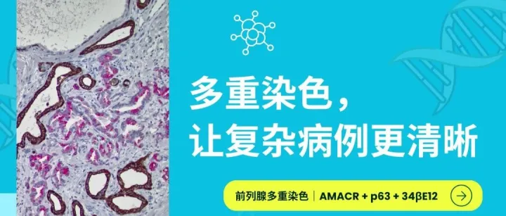 一张切片完成良恶性判断｜AMACR + <em>p63</em> + 34βE12