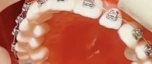 正畸时后牙垫高操作全流程！