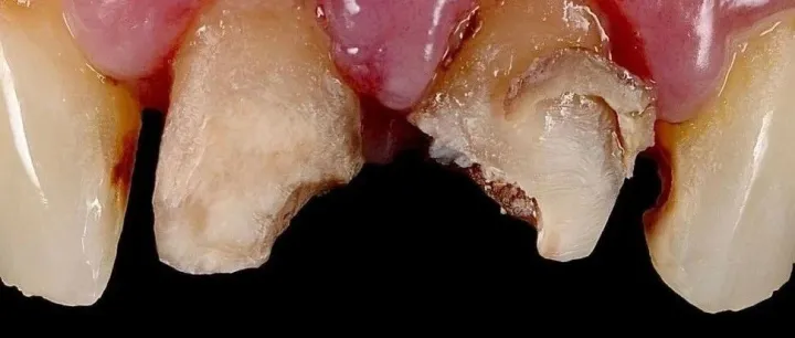 牙医的能力，化腐朽为神奇