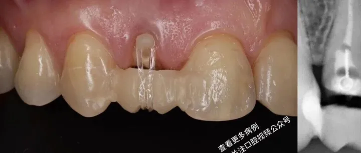 强制伸长术，真的有效吗？