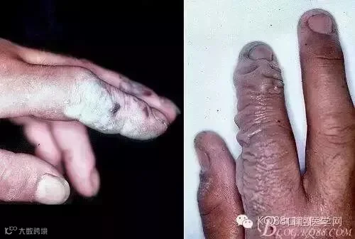 不要命的牙医 要命的氢氟酸