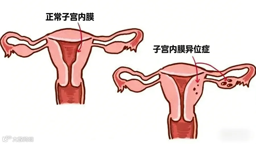子宫内膜异位.png
